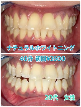 プラチナムビューティー 川口駅前店(PLATINUM BEAUTY)/初回40分照射の照射