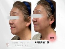 サリューベ(SALUDBE)/何もしなかった肌が変わった。