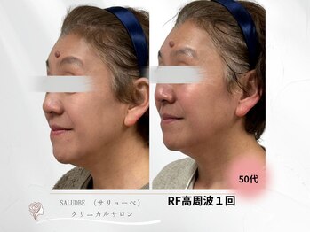 サリューベ(SALUDBE)/何もしなかった肌が変わった。