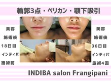 フランジパニ/【インディバ☆美容施術後ケア】