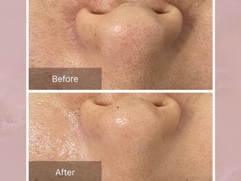 ステラルーテ(Stella lute)/エルモサハーブピーリング 1回