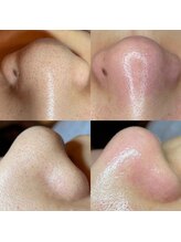 ハスパリ あけぼの町(HASPALI)/tete式毛穴エクストラクション