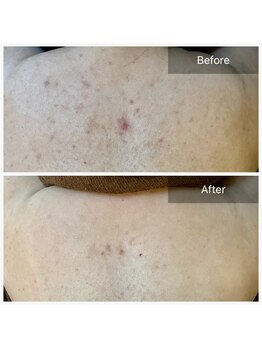 エミルカ(EMILUCA)/ハーブピーリングでお悩み改善