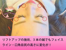健美庵/顔の引き上げ【美容鍼】