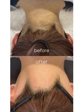 ミモザ(MIMOZA)/襟足.うなじ脱毛♪