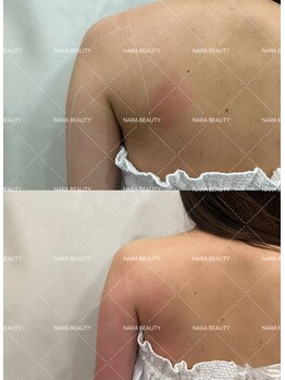 ナラビューティー(NARA BEAUTY)/韓国最新オンタリフト導入!