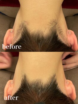 ディオーネ 自由が丘(Dione)/襟足脱毛【20代 &nbsp;施術1回】