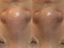 TEN Aesthetic【艶肌・肌質改善・五臓漢方よもぎ蒸し】【7/2　NEW　OPEN（予定）】/TEN Aestheticの毛穴ケアの効果