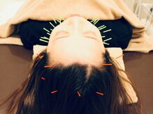 クマノミ美容鍼灸 大宮駅前院(KUMANOMI美容鍼灸)/頭皮からもしっかりリフトUP