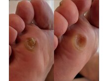 アベビー(Abeby)/ウオノメは大きくなって痛くなる