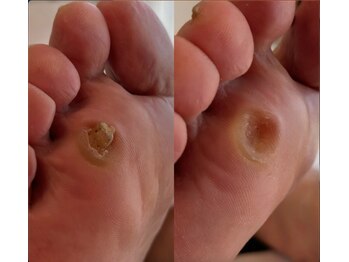 アベビー(Abeby)/ウオノメは大きくなって痛くなる