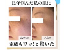 エスポワール(espoir)/シミケア症例