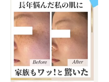 エスポワール(espoir)/シミケア症例