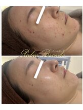 パームボーテ(Palm Beaute)/ポツポツ肌　症例