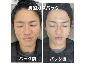 堺整骨院 小郡院/炭酸ガスパック