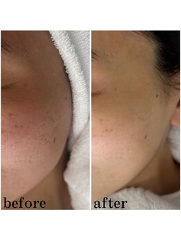 プラセル(Placer)/開き毛穴は変わらない?/毛穴