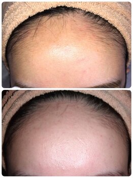 ノノケケ(NONOKEKE)/【レディース|脱毛】　顔脱毛