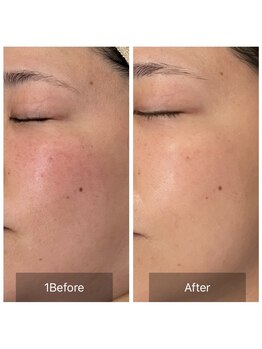 ウィズ ユー ビューティ(with U beauty)/赤みも引いてます