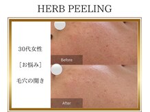 ロージー(ROSY)/ハーブピーリング/阿南/徳島
