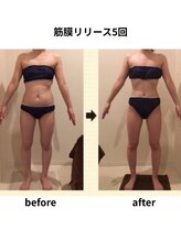 クリア(Clear)/筋膜リリース5回