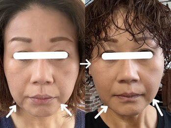 ヴィセラ(Vicella)/フェイスライン悩み任せて下さい