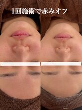 テンニック(10nick)/1回施術で赤みオフ