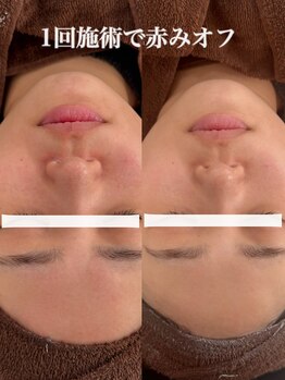 テンニック(10nick)/1回施術で赤みオフ
