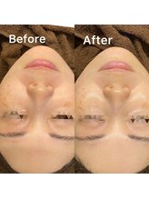 モア(MOA)/ハーブピーリングで透明感を♪