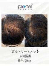 ユミト(Umit)/プロセルスカルプ