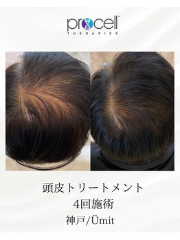 ユミト(Umit)/プロセルスカルプ