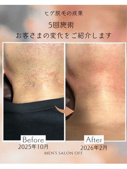 オフ(off)/ヒゲ脱毛