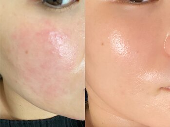 アルカンシエル(arcenciel)の写真/繰り返すニキビに、今度こそ向き合う肌質改善。隠す毎日から、ノーファンデでも自信が持てる素肌へ。