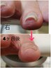 《再来》巻き爪ケア【前回から4week以上たっている】１本