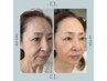 【医師監修】細胞レベルの再生美容 ［ExoLiftエクソリフト］南大阪初導入