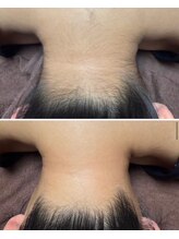 ミリプラス(MiLi +)/うなじ/襟足/産毛