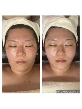 BBC 田園調布/小顔コルギ効果