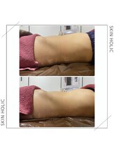 スキンホリック 恵比寿駅前店(SKIN HOLIC)/お腹☆ビフォア＆アフター★