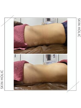 スキンホリック 恵比寿駅前店(SKIN HOLIC)/お腹☆ビフォア＆アフター★