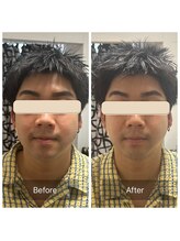 ダンニヒル(dannihil)/【小顔矯正】20代自営業初回