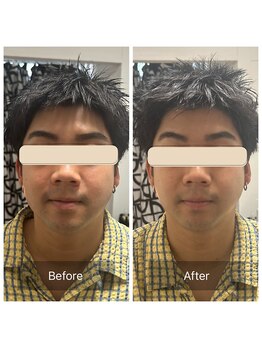 ダンニヒル(dannihil)/【小顔矯正】20代自営業初回