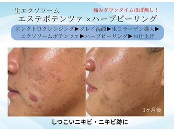 エイミー(Aimee)/長年のニキビ悩みに終止符