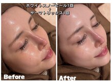 アムールドゥ 麻布十番(Amour deux)/ホワイトスノーピール＆サーマ