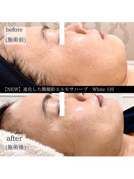 ケイリー(kaylee)/ハーブピーリング