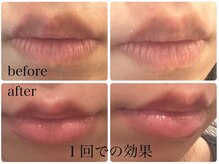 ブリリオ 池袋店(Brillio)/ぷっくリップ施術/一回での効果
