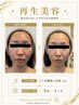【平日5名限定】赤ら顔・繰り返す赤みに｜再生美容フェイシャル