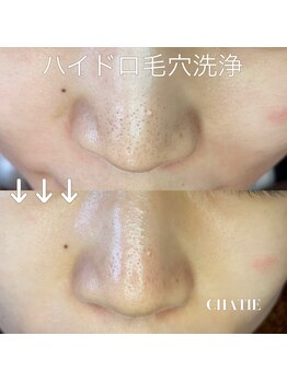 チャティー(CHATIE)/高濃度水素ハイドロ毛穴洗浄