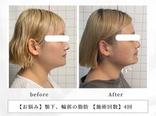 レッド(RED)/歪み・厚み・食いしばりの改善