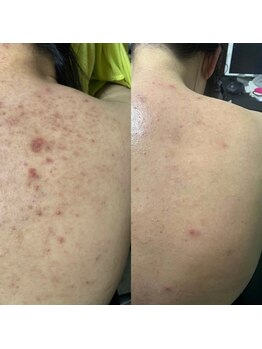 ウイユ(Oeil)/剥けるハーブピーリング 効果2回