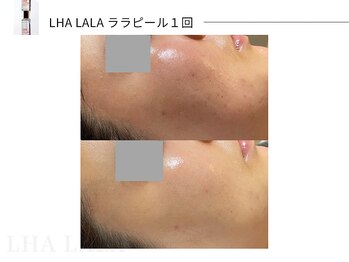 スパレーカ(Spa laka)/ララピール