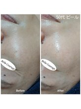 ベルクラージュ(Belle Courage)/40代　くすみ・毛穴・シワ